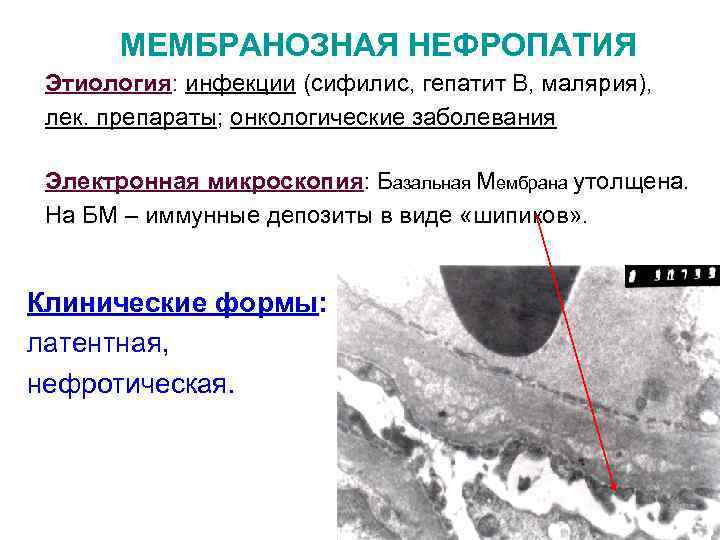 Митохондриальные энцефаломиопатии презентация