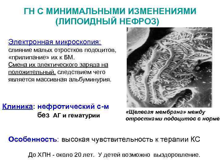 ГН С МИНИМАЛЬНЫМИ ИЗМЕНЕНИЯМИ (ЛИПОИДНЫЙ НЕФРОЗ) Электронная микроскопия: слияние малых отростков подоцитов, «прилипание» их