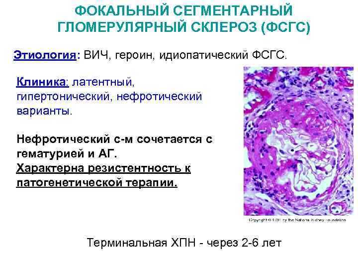 ФОКАЛЬНЫЙ СЕГМЕНТАРНЫЙ ГЛОМЕРУЛЯРНЫЙ СКЛЕРОЗ (ФСГС) Этиология: ВИЧ, героин, идиопатический ФСГС. Клиника: латентный, гипертонический, нефротический