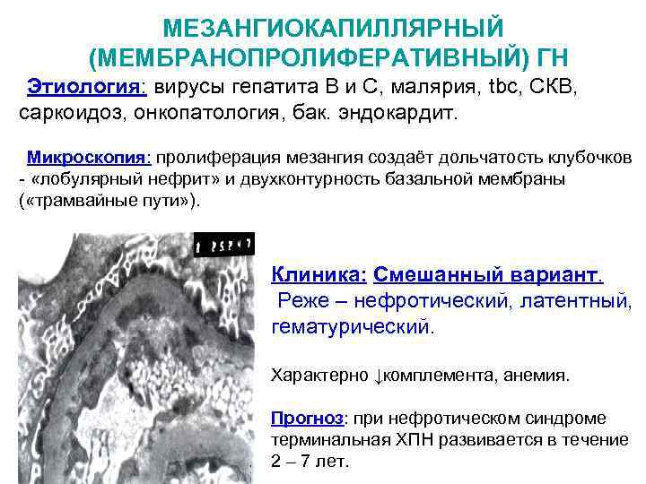 МЕЗАНГИОКАПИЛЛЯРНЫЙ (МЕМБРАНОПРОЛИФЕРАТИВНЫЙ) ГН Этиология: вирусы гепатита В и С, малярия, tbc, СКВ, саркоидоз, онкопатология,