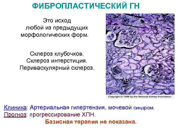 ФИБРОПЛАСТИЧЕСКИЙ ГН Это исход любой из предыдущих морфологических форм. Склероз клубочков. Склероз интерстиция. Периваскулярный