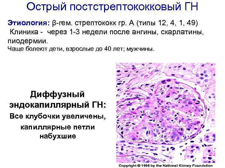 Острый постстрептококковый ГН Этиология: β-гем. стрептококк гр. А (типы 12, 4, 1, 49) Клиника