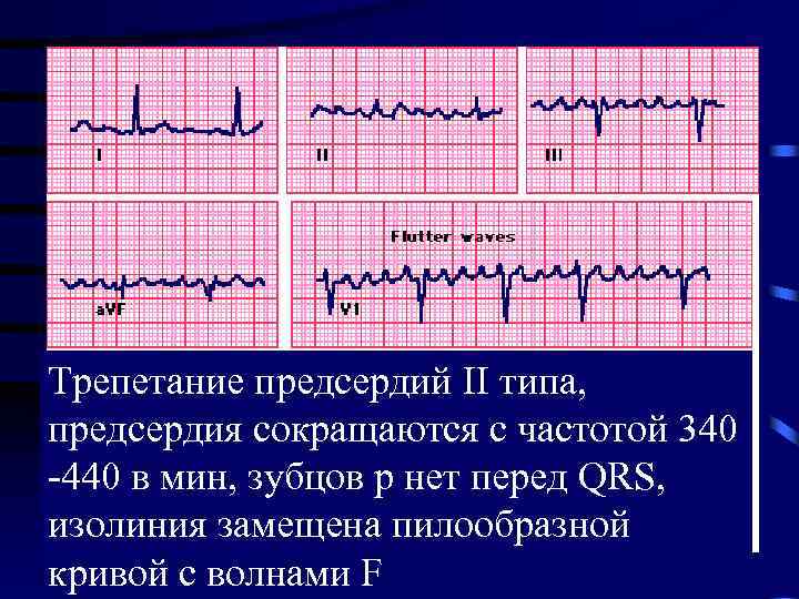 Волны при трепетании предсердий. Трепетание предсердий 2 типа. Трепетание предсердий Тип 1 и 2. Трепетание предсердий атипичная форма на ЭКГ. Трепетание предсердий 2:1.