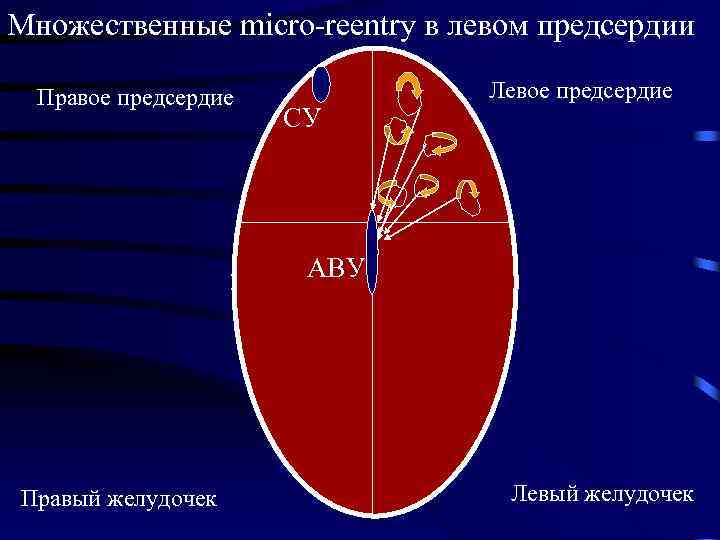 Множественные micro-reentry в левом предсердии Правое предсердие СУ Левое предсердие АВУ Правый желудочек Левый