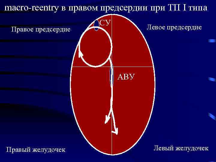 mаcro-reentry в правом предсердии при ТП I типа Правое предсердие СУ Левое предсердие