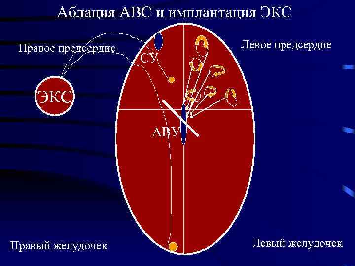 Аблация АВС и имплантация ЭКС Правое предсердие СУ Левое предсердие ЭКС АВУ Правый желудочек