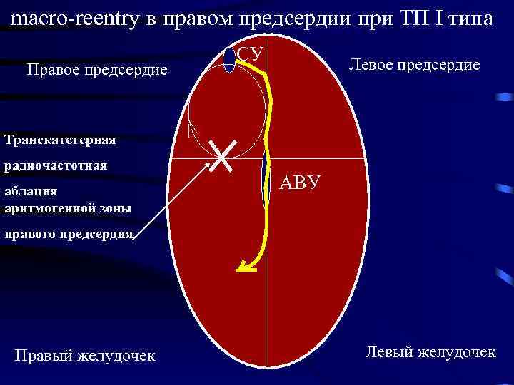 mаcro-reentry в правом предсердии при ТП I типа Правое предсердие СУ Левое предсердие