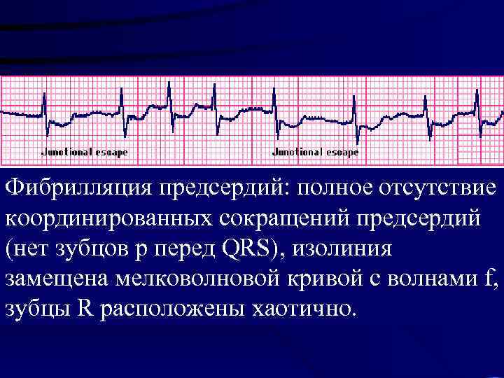 Волны при трепетании предсердий. Крупноволновая фибрилляция предсердий. Атриальная фибрилляция. Фибрилляция предсердий волны f.