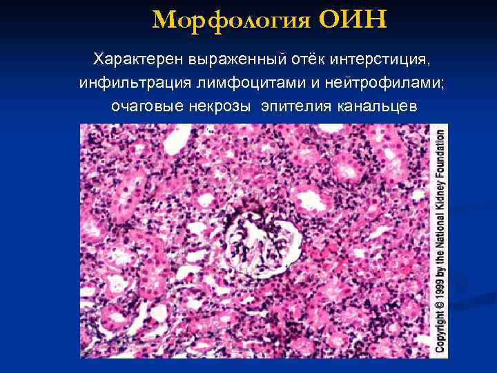 Морфология ОИН Характерен выраженный отёк интерстиция, инфильтрация лимфоцитами и нейтрофилами; очаговые некрозы эпителия канальцев