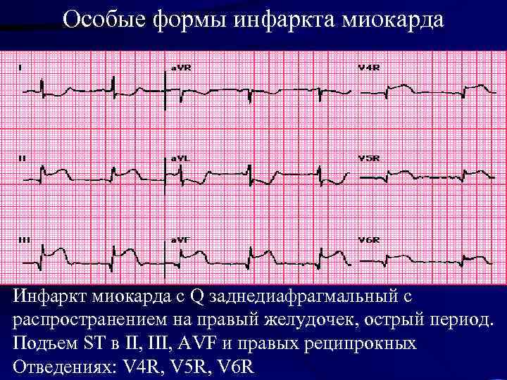 Особые формы инфаркта миокарда Инфаркт миокарда с Q заднедиафрагмальный с распространением на правый желудочек,