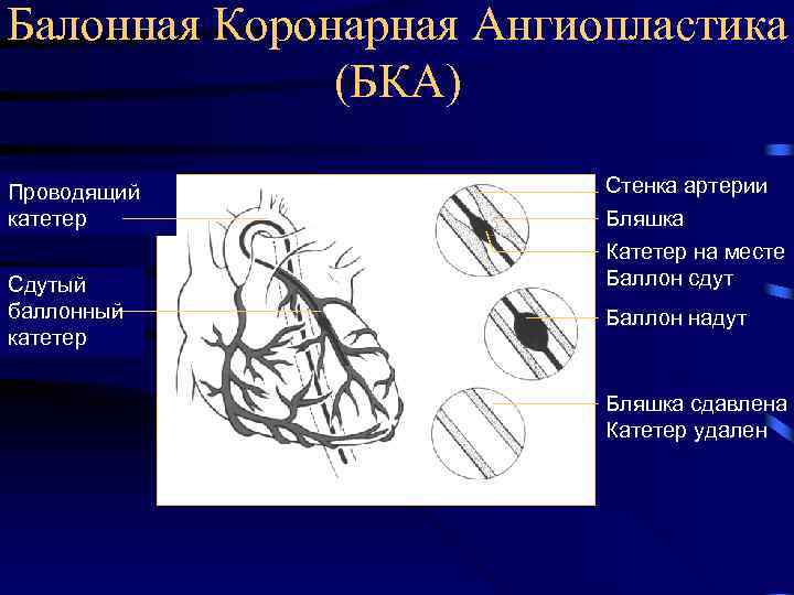 Балонная Коронарная Ангиопластика (БКА) Проводящий катетер Сдутый баллонный катетер Стенка артерии Бляшка Катетер на