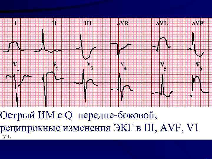 Острый ИМ с Q передне-боковой, реципрокные изменения ЭКГ в III, AVF, V 1 