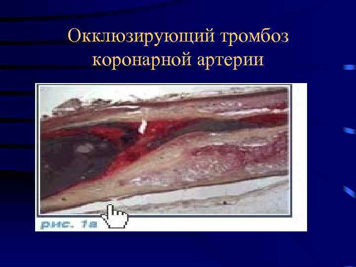 Окклюзирующий тромбоз коронарной артерии 
