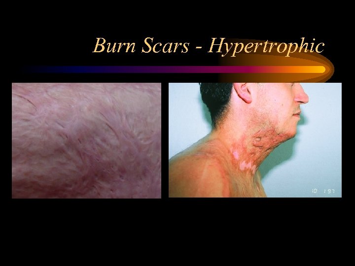 Burn Scars - Hypertrophic 