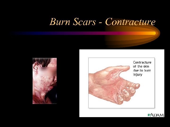 Burn Scars - Contracture 