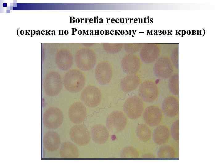 Borrelia recurrentis (окраска по Романовскому – мазок крови) 