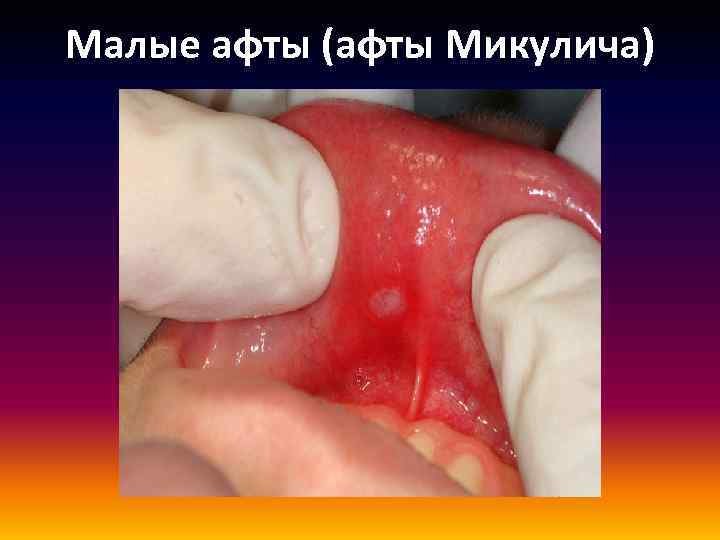 Малые афты (афты Микулича) 