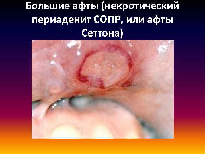 Большие афты (некротический периаденит СОПР, или афты Сеттона) 