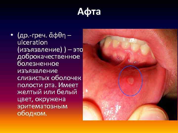 Афта • (др. -греч. ἄφθη – ulceration (изъязвление) ) – это доброкачественное болезненное изъязвление