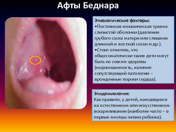 Афты Беднара Этиологические факторы: • Постоянная механическая травма слизистой оболочки (давление грубого соска матери