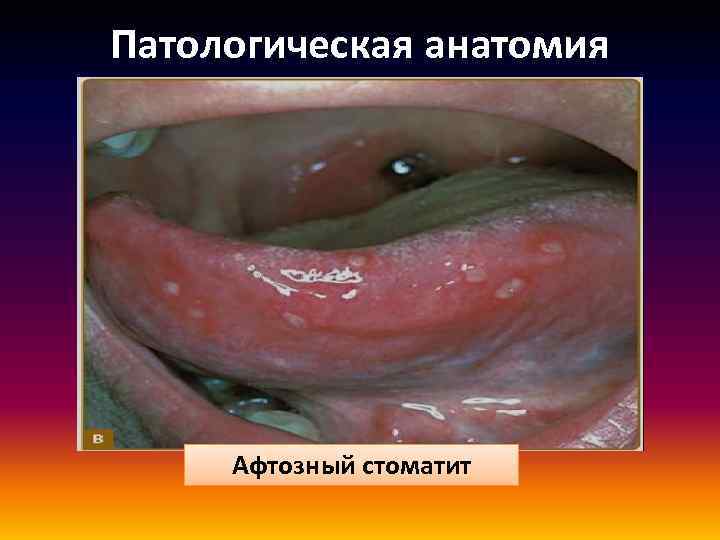 Патологическая анатомия Афтозный стоматит 