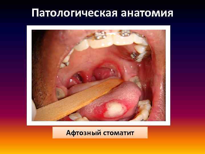 Патологическая анатомия Афтозный стоматит 
