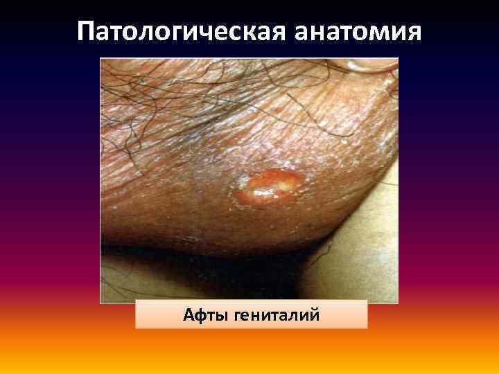 Патологическая анатомия Афты гениталий 