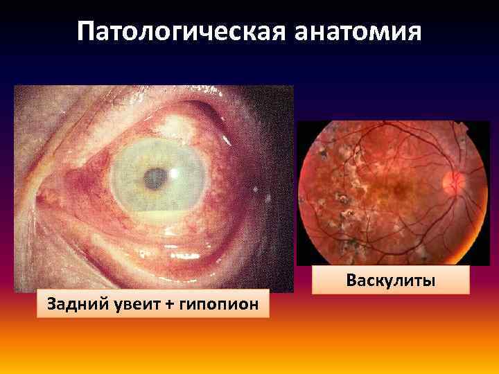 Патологическая анатомия Задний увеит + гипопион Васкулиты 