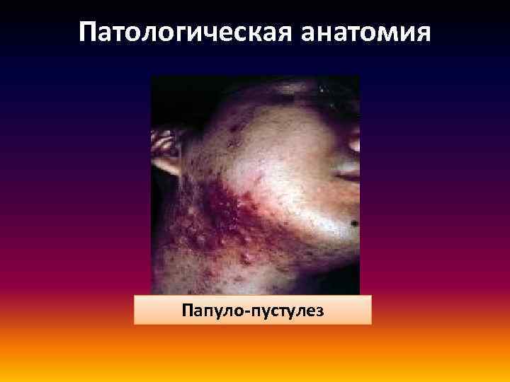 Патологическая анатомия Папуло-пустулез 