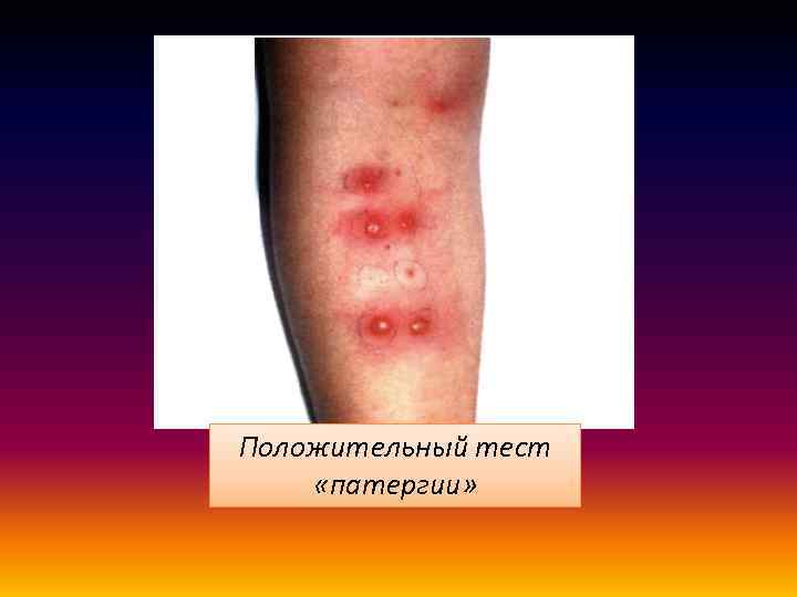 Положительный тест «патергии» 