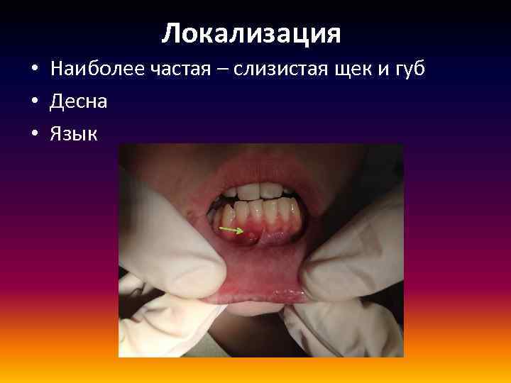 Локализация • Наиболее частая – слизистая щек и губ • Десна • Язык 
