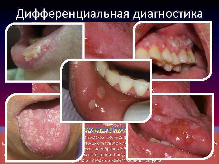 Дифференциальная диагностика Эксфолиативный хейлит Красный плоский лишай Нижняя губа отечна, с белесоватыми очажками, имеются