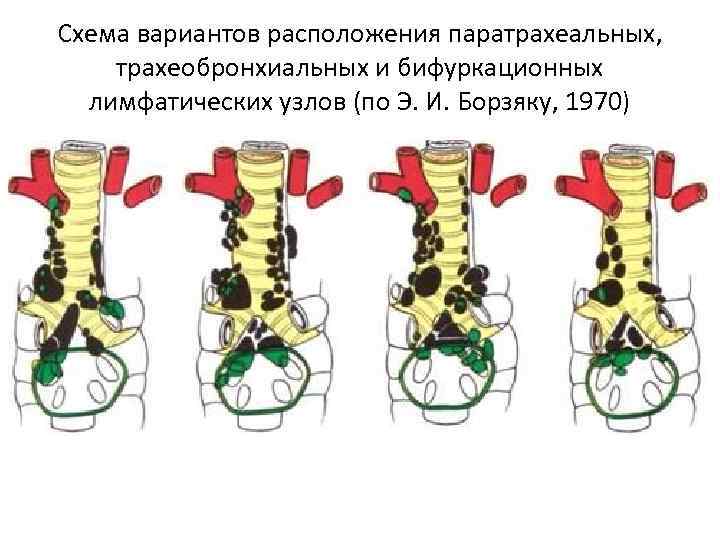 Схема вариантов расположения паратрахеальных, трахеобронхиальных и бифуркационных лимфатических узлов (по Э. И. Борзяку, 1970)