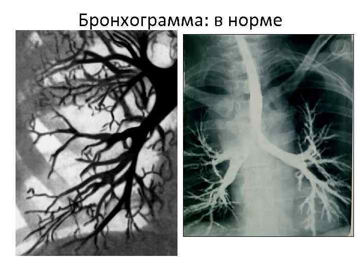 Бронхограмма: в норме 