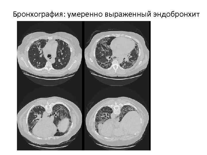 Бронхография: умеренно выраженный эндобронхит 