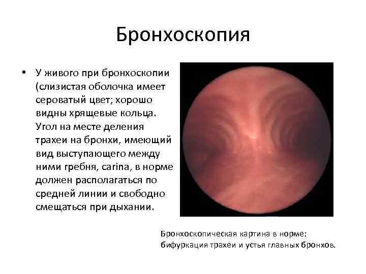 Бронхоскопия • У живого при бронхоскопии (слизистая оболочка имеет сероватый цвет; хорошо видны хрящевые