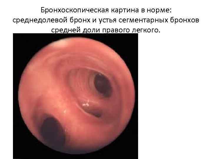 Бронхоскопическая картина в норме: среднедолевой бронх и устья сегментарных бронхов средней доли правого легкого.