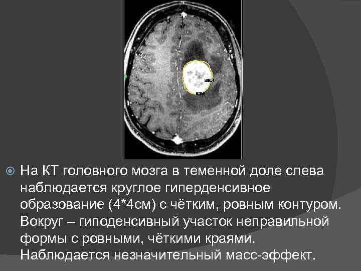 Что значит очаг в головном мозге. Гиперденсивный очаг в головном мозге кт. Гиподенсивный очаг кт головного мозга. Гиподенсивные очаги головного мозга что это такое. Гиперденсивное образование головного мозга на кт.