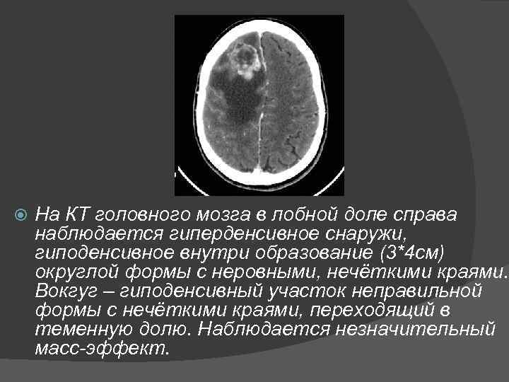  На КТ головного мозга в лобной доле справа наблюдается гиперденсивное снаружи, гиподенсивное внутри