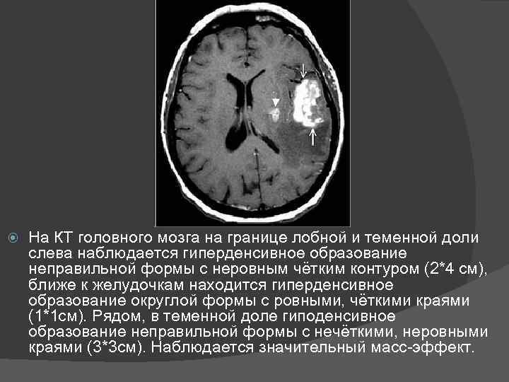  На КТ головного мозга на границе лобной и теменной доли слева наблюдается гиперденсивное