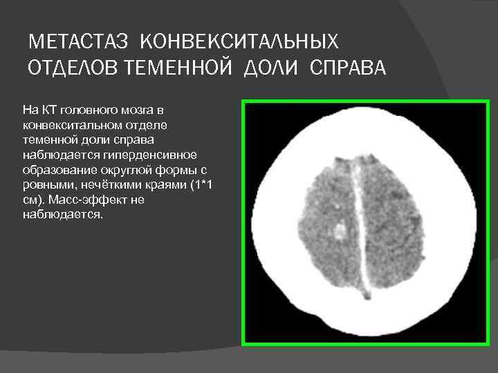 МЕТАСТАЗ КОНВЕКСИТАЛЬНЫХ ОТДЕЛОВ ТЕМЕННОЙ ДОЛИ СПРАВА На КТ головного мозга в конвекситальном отделе теменной