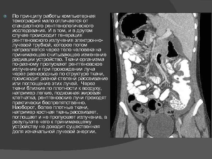  По принципу работы компьютерная томография мало отличается от стандартного рентгенологического исследования. И в