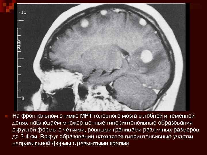 n На фронтальном снимке МРТ головного мозга в лобной и теменной долях наблюдаем множественные