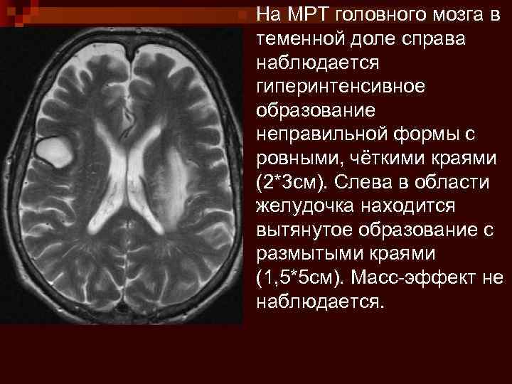 n На МРТ головного мозга в теменной доле справа наблюдается гиперинтенсивное образование неправильной формы
