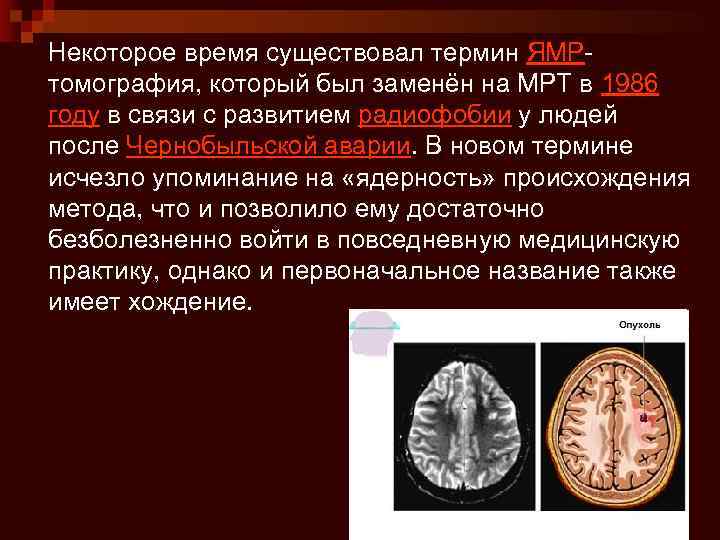 Некоторое время существовал термин ЯМРтомография, который был заменён на МРТ в 1986 году в