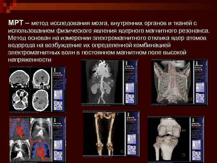 МРТ – метод исследования мозга, внутренних органов и тканей с использованием физического явления ядерного