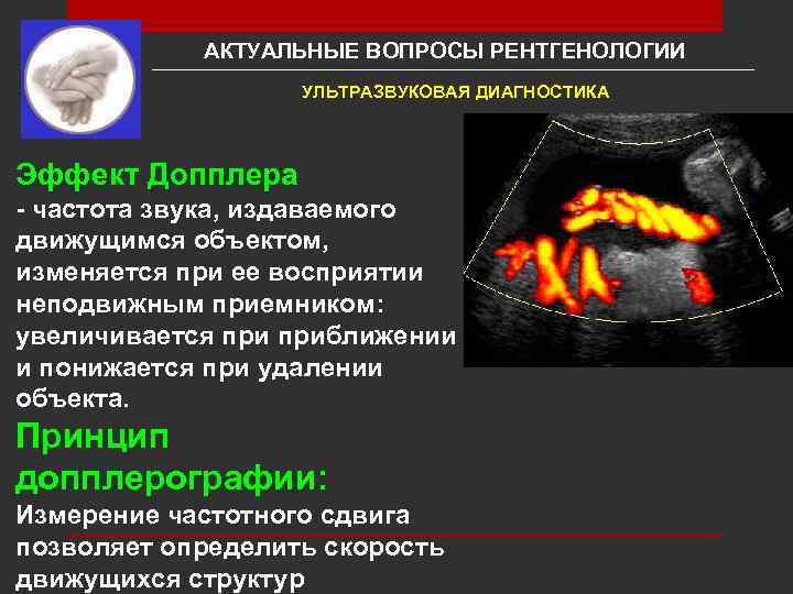 АКТУАЛЬНЫЕ ВОПРОСЫ РЕНТГЕНОЛОГИИ УЛЬТРАЗВУКОВАЯ ДИАГНОСТИКА Эффект Допплера - частота звука, издаваемого движущимся объектом, изменяется
