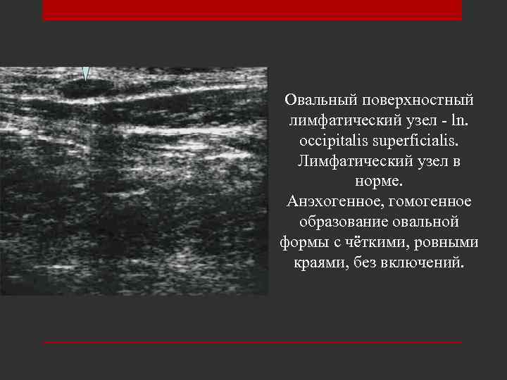 Овальный поверхностный лимфатический узел - ln. occipitalis superficialis. Лимфатический узел в норме. Анэхогенное, гомогенное
