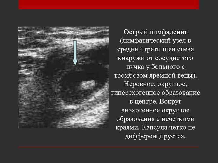 Острый лимфаденит (лимфатический узел в средней трети шеи слева кнаружи от сосудистого пучка у