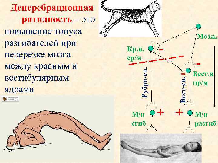 Мозж. М/н сгиб - Вест-сп. Кр. я. ср/м Рубро-сп. Децеребрационная ригидность – это повышение